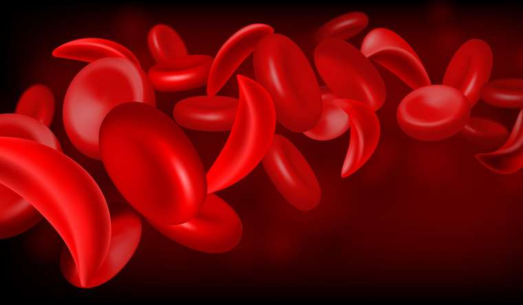 It is time to prioritise Sickle Cell Disease care in India