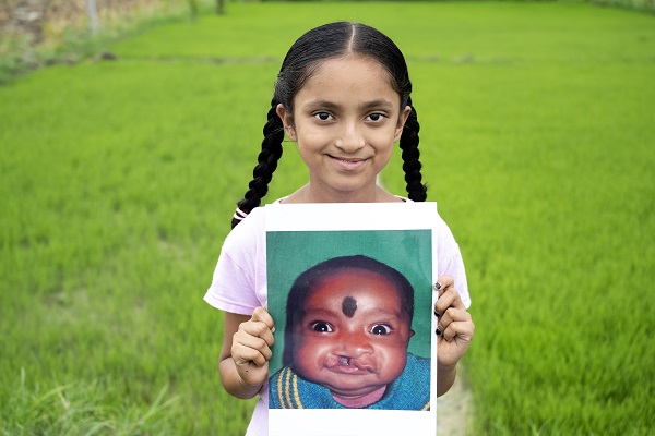 Smile Train India & Sirat Unite to Empower Cleft Community